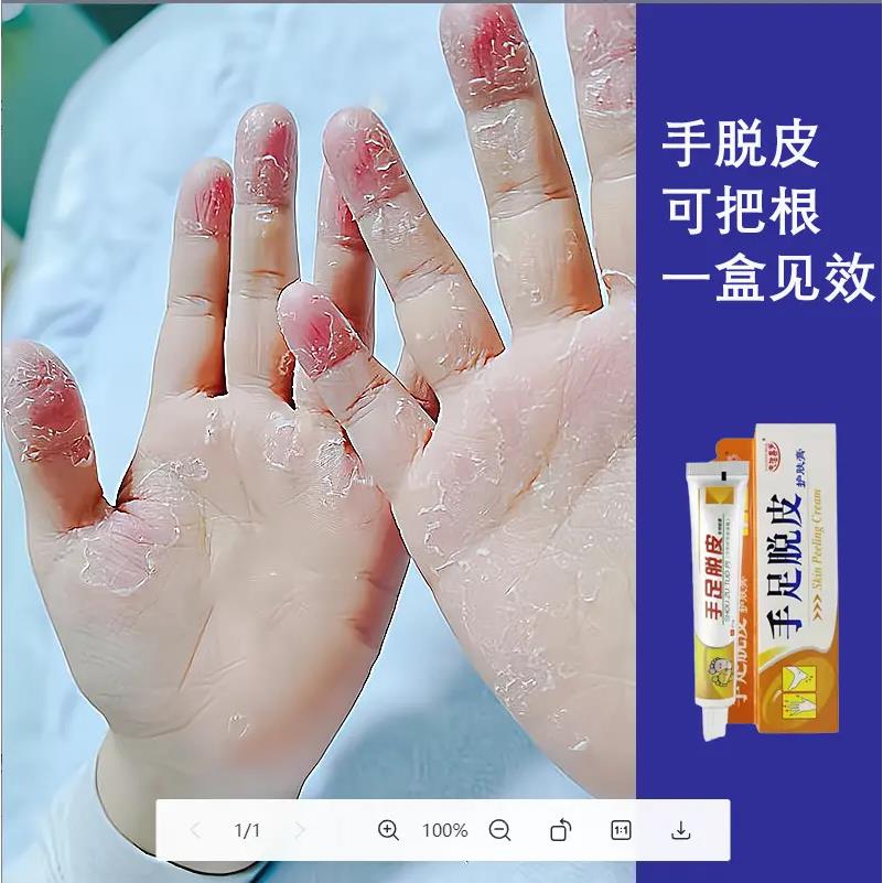 学生缺乏维生素手脱皮手干燥裂口子草本精华抑菌温和舒缓手足脱皮