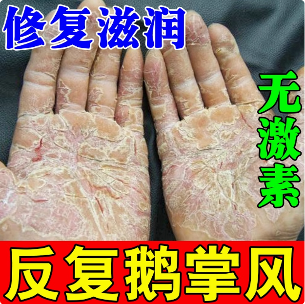 鹅掌风手脱皮脚底板脱皮脚心痒脚痒起水泡起皮脚后跟干燥起皮裂口