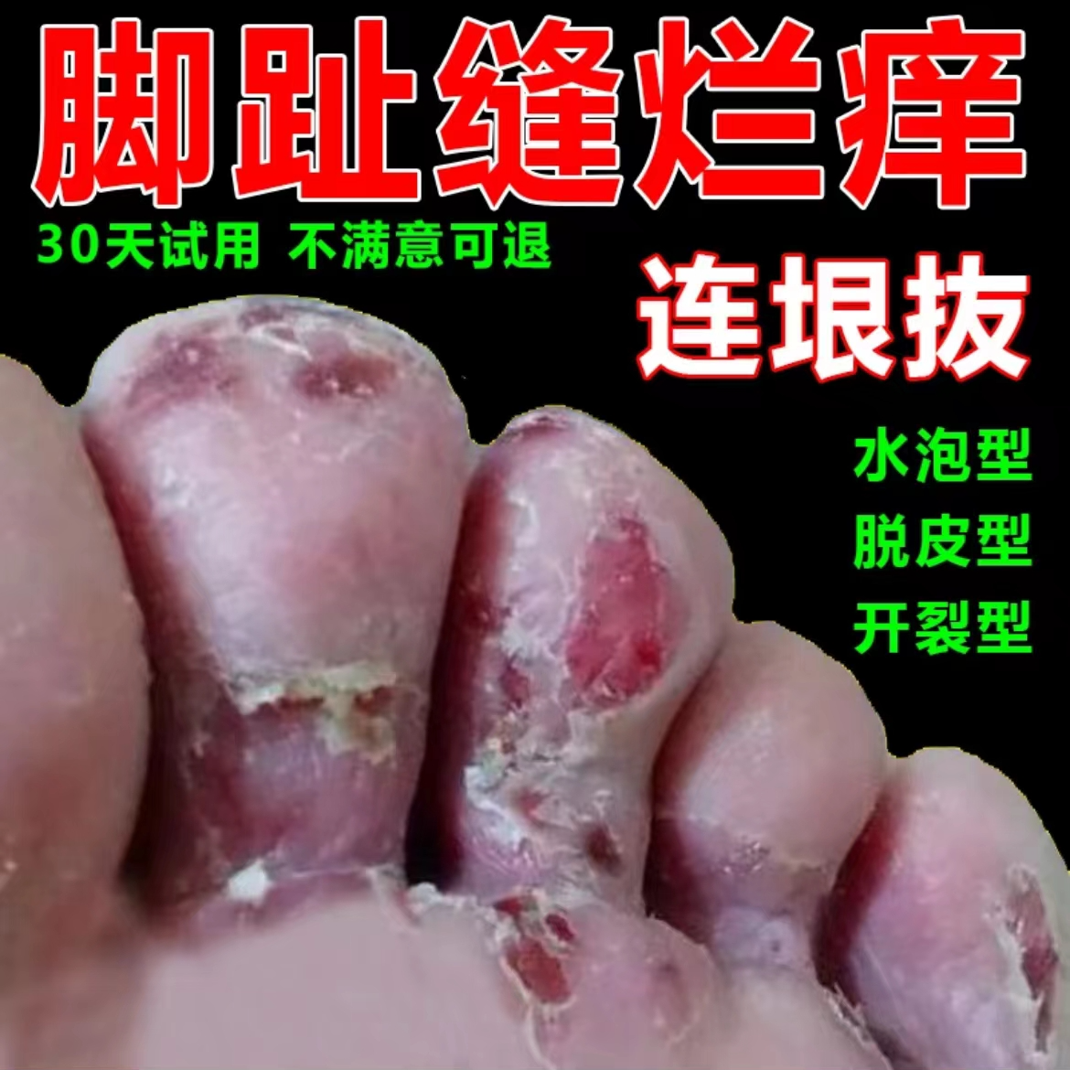 止痒去脚出汗脱皮起水炮干裂脚趾缝痒抑菌止痒神器足部护理发