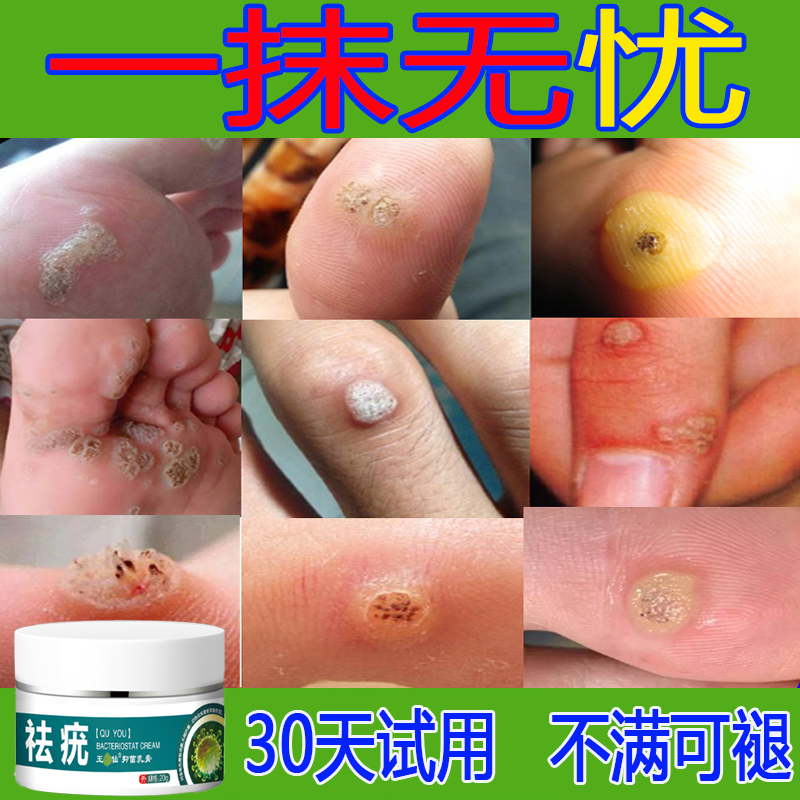 【香港大藥房】手脚上皮肤袪尤克星脚底头皮肉刺草本植物精华乳膏
