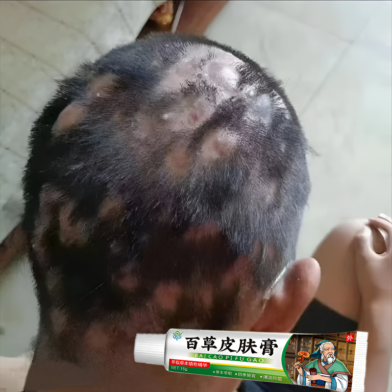 头皮毛囊堵塞起疙瘩头皮起红豆豆头顶长头皮屑头部晒伤修复护理膏