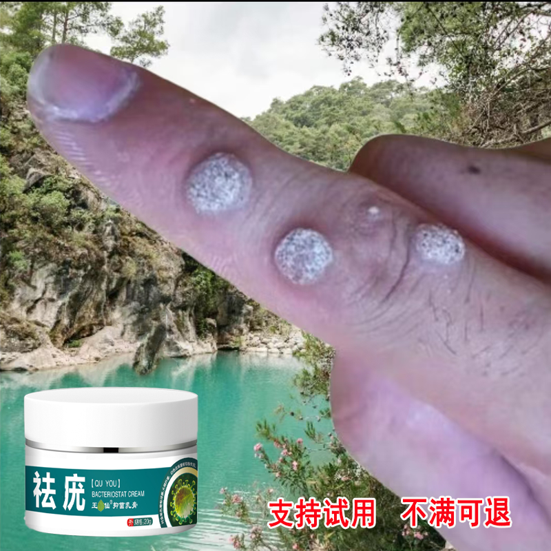 手指凸起小疙瘩扁平手足寻常疙瘩脖子腋下肉粒丝状肉钉草本外用膏