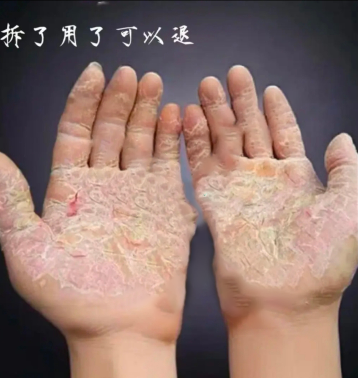手脱皮手足脱皮膏手痒手脱皮皮肤干燥起皮脱皮手脚脱皮护理软膏膏