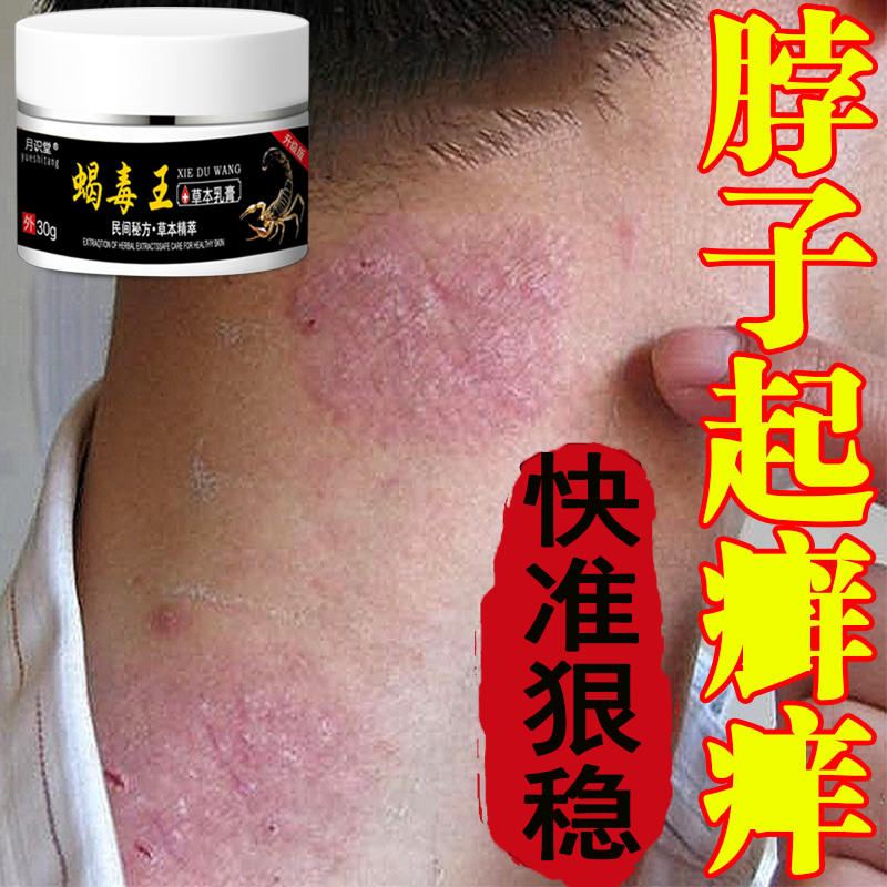 【牛藓痒克星】全身红点痒皮肤止痒去顽固根手足体股藓正品止痒乳膏