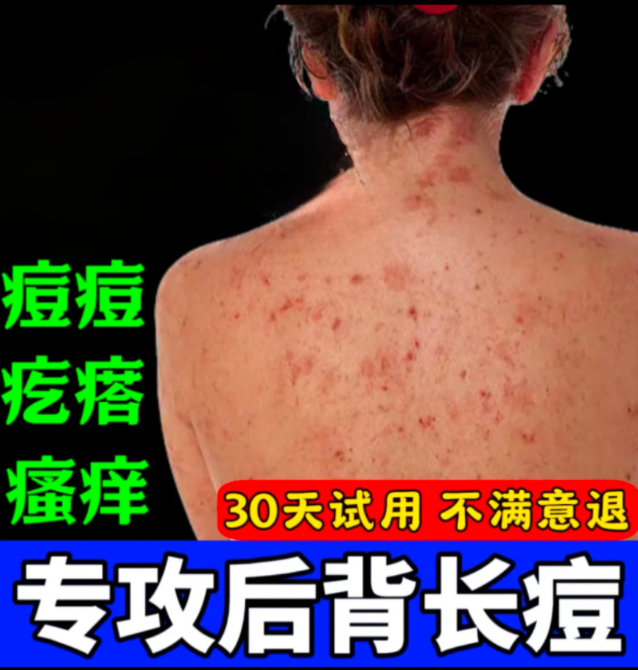  [随风专属]后背毛囊痘痘背上胸前脖子头皮去除止痒软膏皮肤抑菌