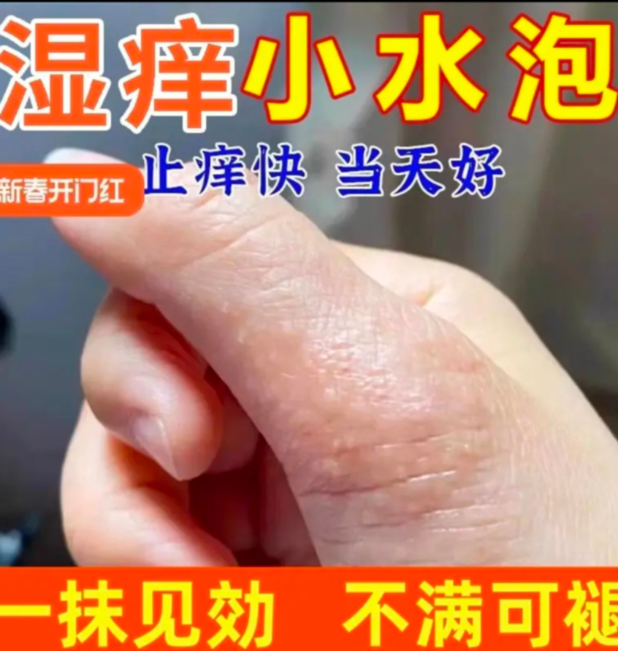 汗珍泡手上起小水泡止痒膏脱皮抑菌手指缝痒干裂专用草本乳膏