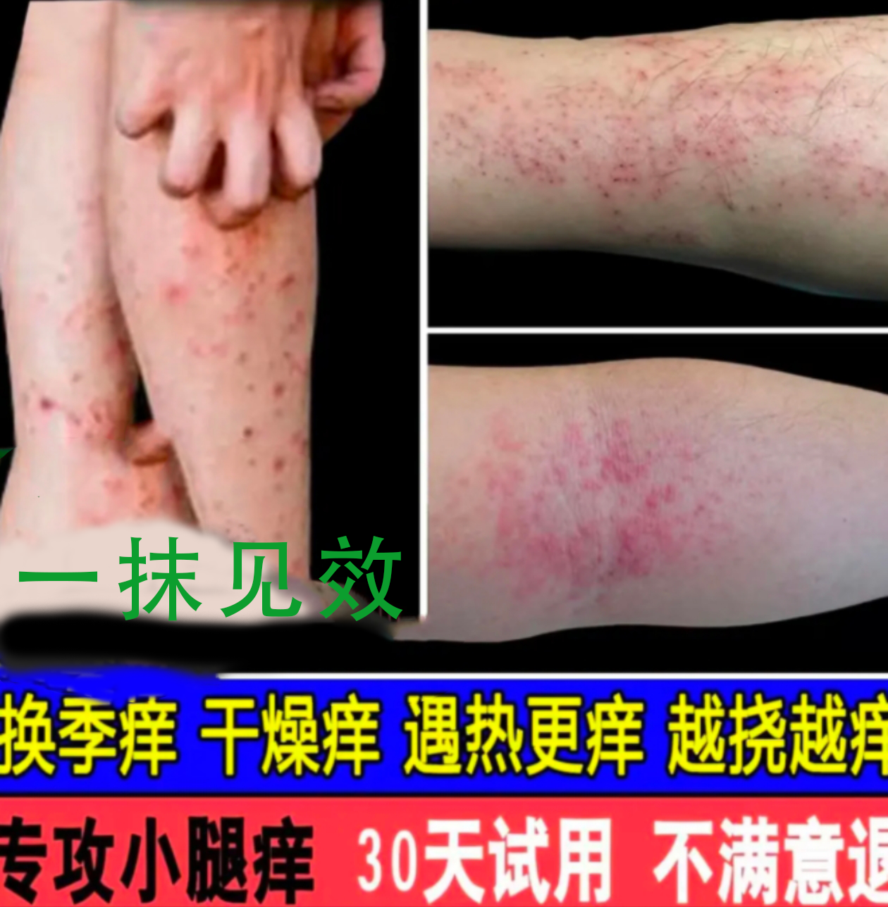 腿上皮肤干燥发痒小腿皮肤痒秋冬天腿上很痒越抓越痒止痒膏草本