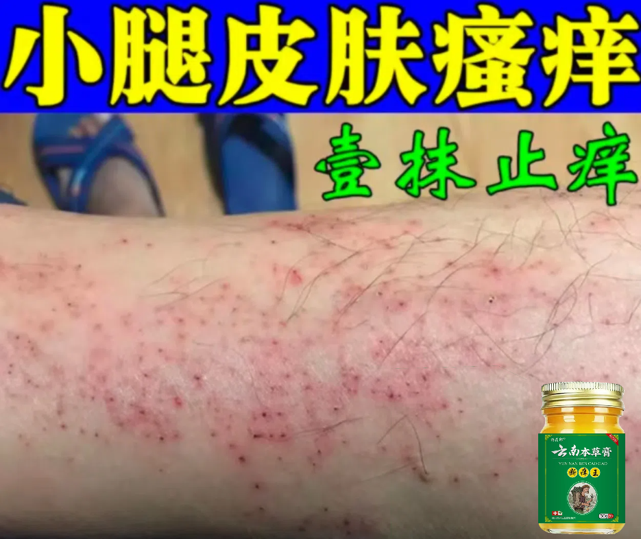 小腿皮肤痒腿上起红疙瘩痒长红点老年人皮肤瘙痒特效止痒抑菌乳膏