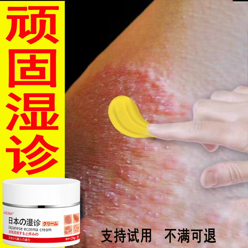顽固湿珍皮肤诊瘙痒干痒湿痒止痒膏全身可用皮肤湿痒外用抑菌乳膏