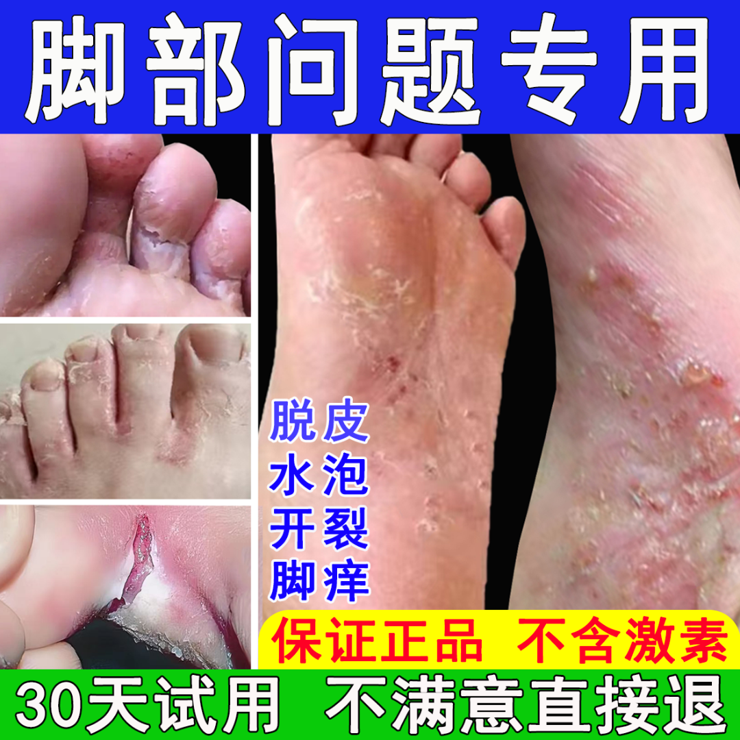 脚痒专用抑菌止痒膏脚臭气干裂脱皮起水泡汗脚趾缝痒喷剂克星神器