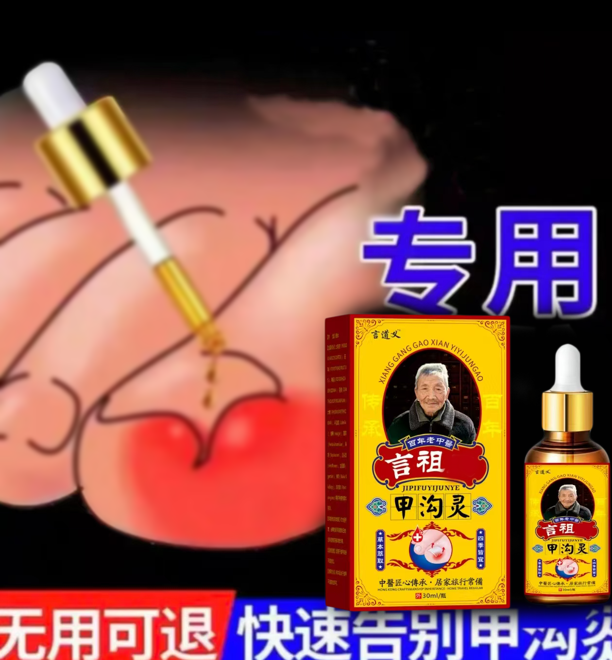 指甲长肉里脚趾脓嵌甲肉芽脚指头疼甲沟膏 