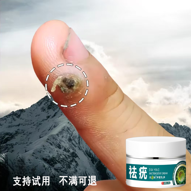 手指凸起小疙瘩扁平手足寻常疙瘩脖子腋下肉粒丝状肉钉温和液