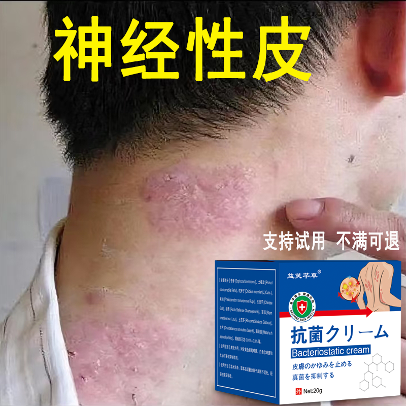 【神经性皮肤止痒膏】真菌克星全身手足湿痒顽固特效草本修复过敏膏