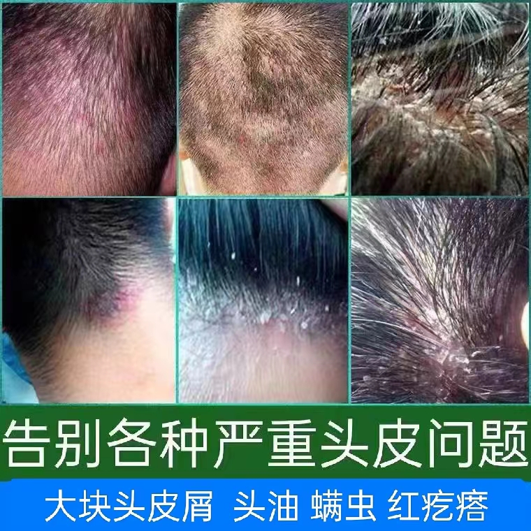 头部大块头皮屑头皮红疙瘩大块头皮屑去屑止痒除螨膏抑菌控油乳膏