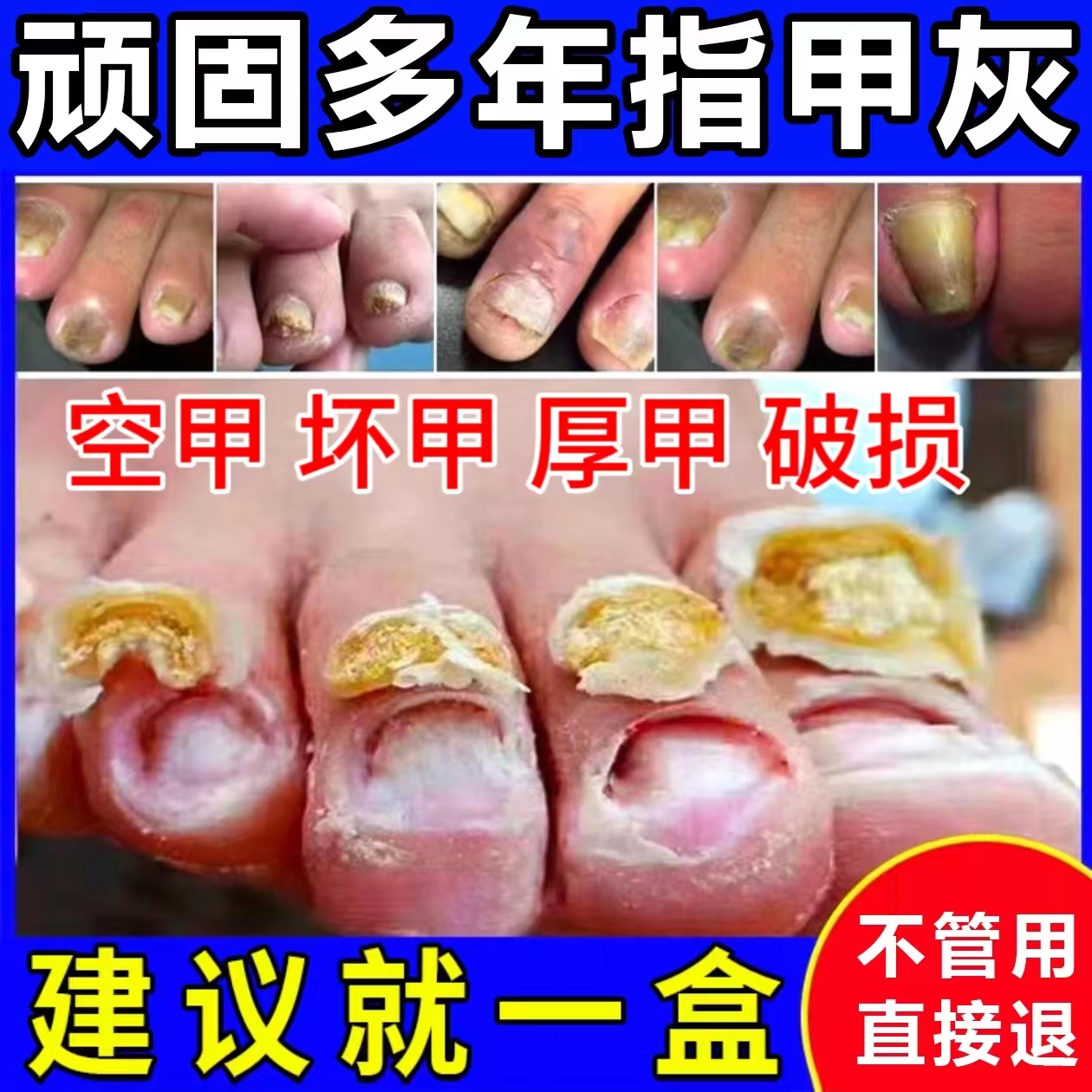 【严重】灰指甲专用液亮甲正品抑菌液快速去坏软甲修护脚指甲专用