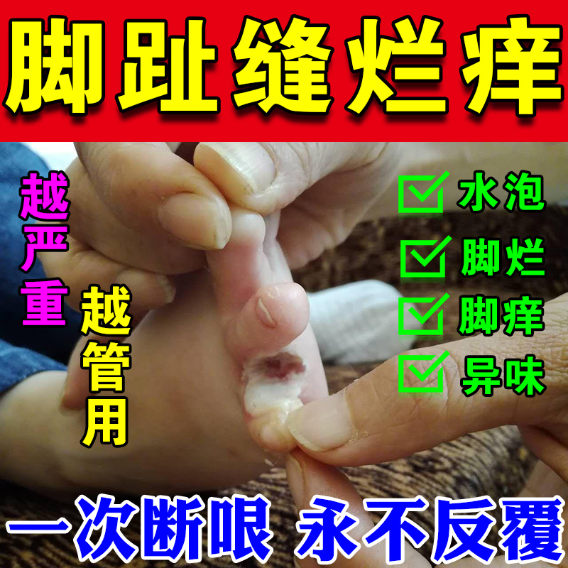 烂脚丫脱皮糜烂脚趾缝烂痒开裂脚指头痒起水泡杀i菌止i痒专用膏