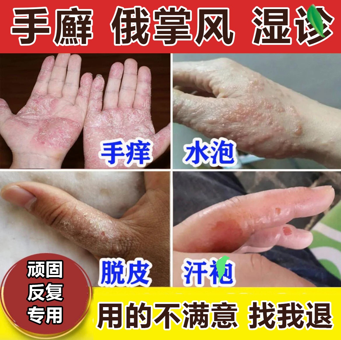 手足脱皮膏止痒喷雾剂手起水泡脱皮干裂防裂皮肤干痒湿痒干燥护理