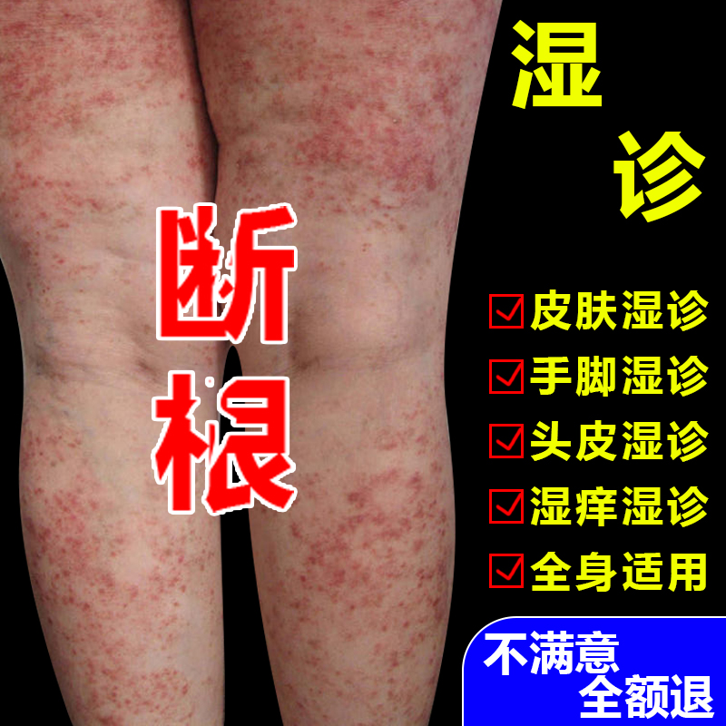 云南滇草湿痒膏皮肤抑菌止痒王红点疙瘩起泡头皮干痒湿痒喷雾剂