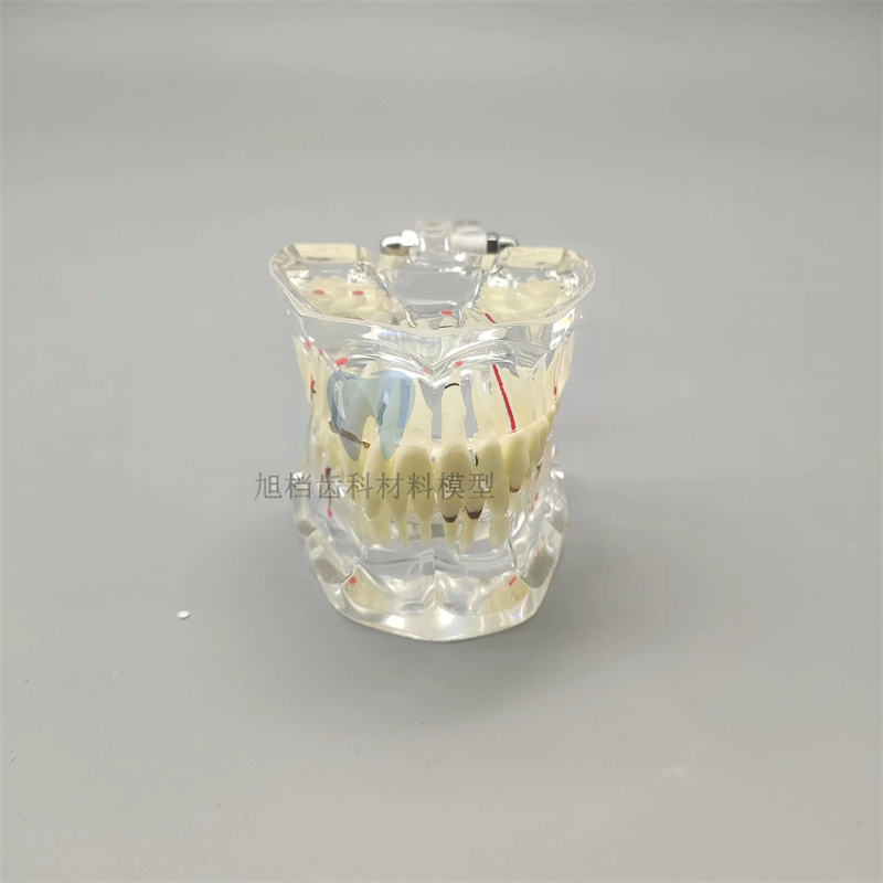 补牙模型活动修复病理树脂不缺牙正畸医患沟通口腔教学牙科种植