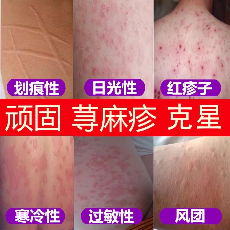荨麻专用膏特效过敏急慢性胆碱划痕风团性皮肤瘙痒湿疹止痒膏