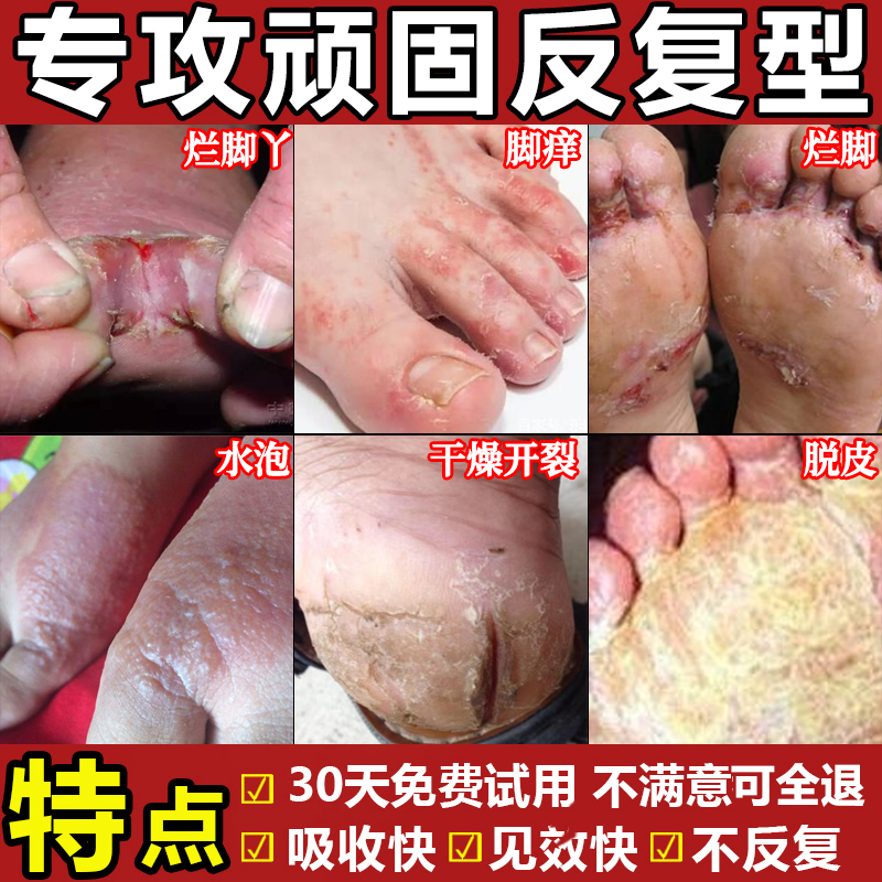 脚痒脱皮起水泡又痒又脱皮脚趾缝痒喷雾剂抑菌膏足部脚臭止痒神器