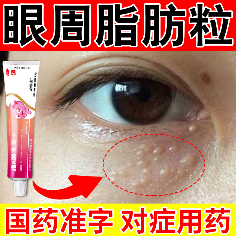 尤维佳维A酸乳膏0.1%*15g 角化异常眼周脂肪药膏粒眼睛周围有白色颗粒脂肪粒
