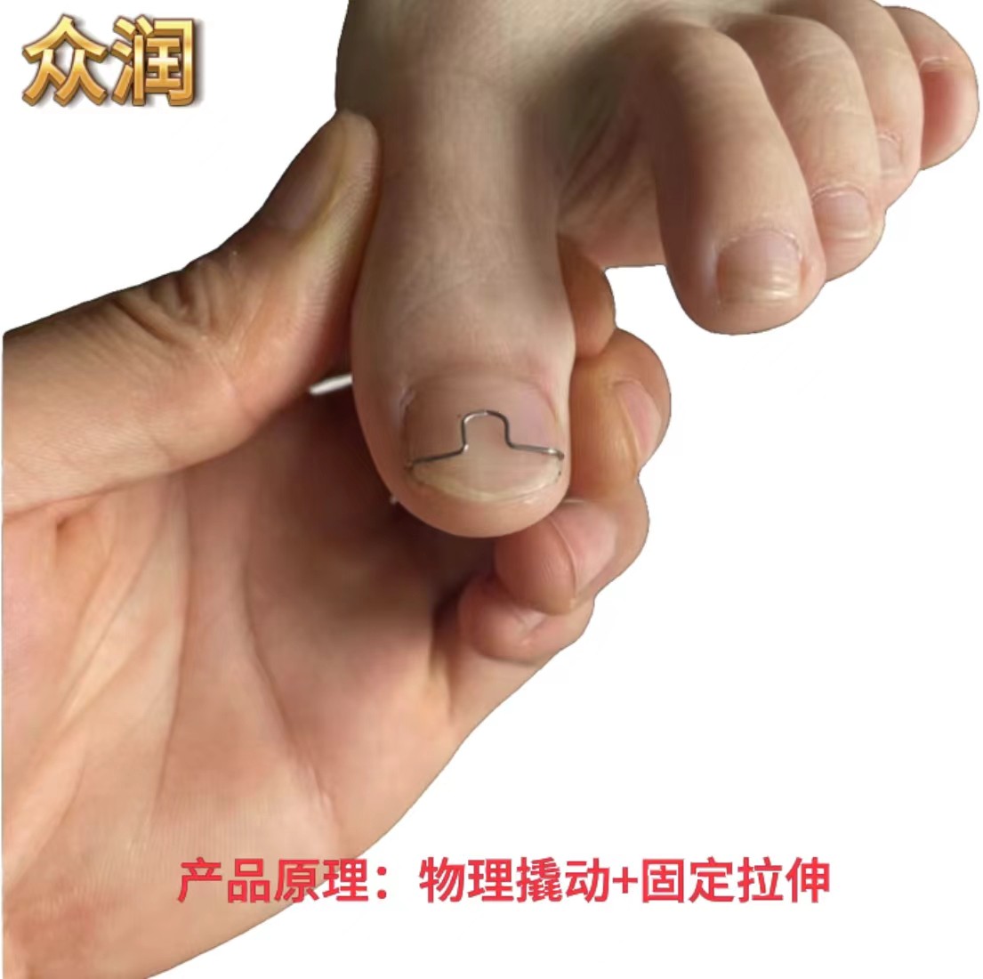 众润甲沟炎矫正钩嵌甲矫正正甲扣甲沟专用嵌甲矫正脚趾甲扎肉贴片
